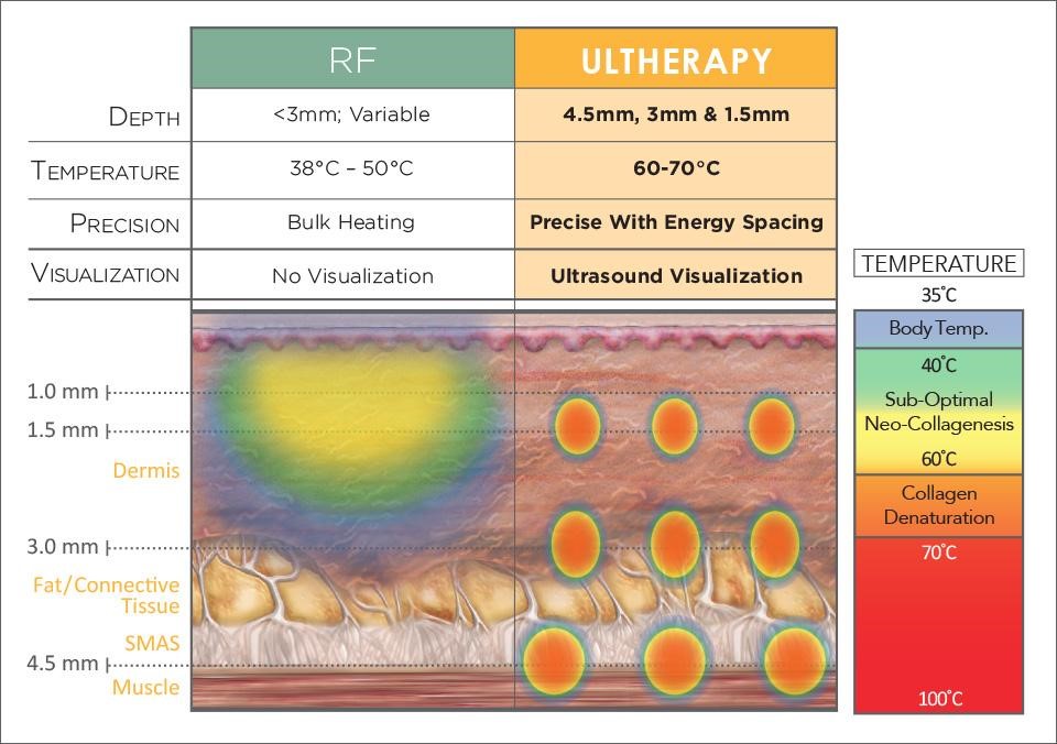Difference Between Ultherapy & RF Devices