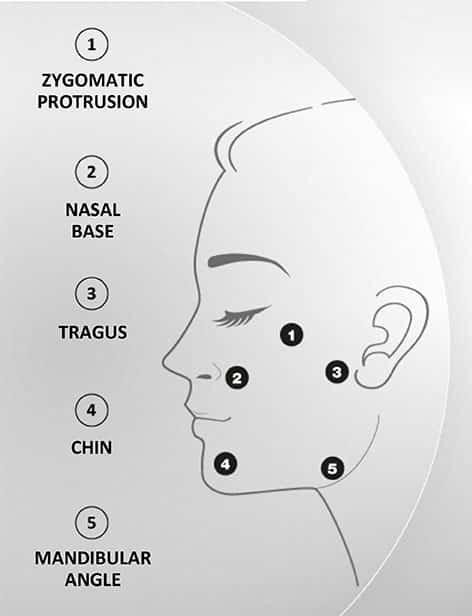 face treatment using Profhilo