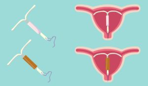 Birth control - IUD