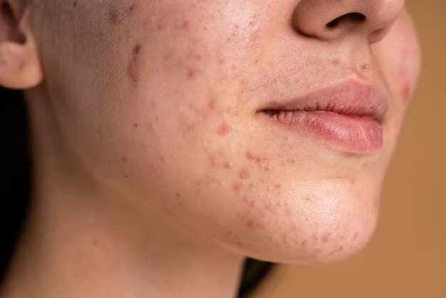 a young woman with acne close-up