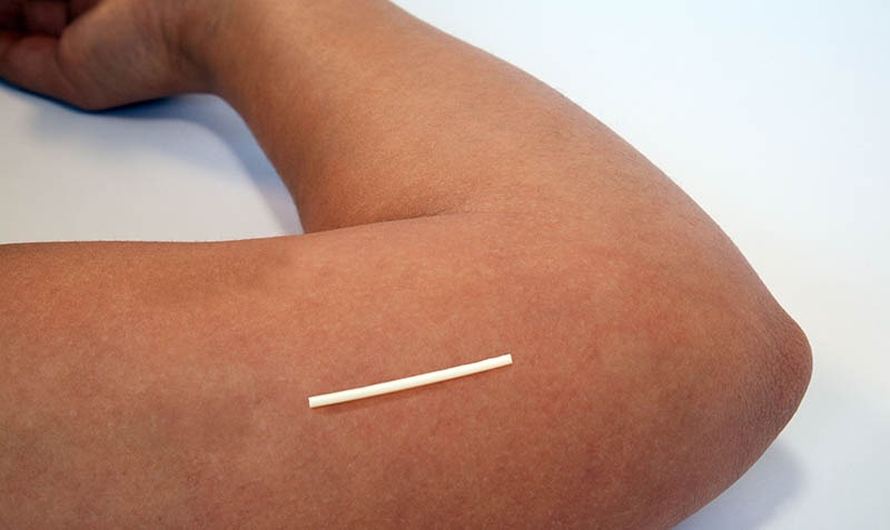 Contraceptive Implants 