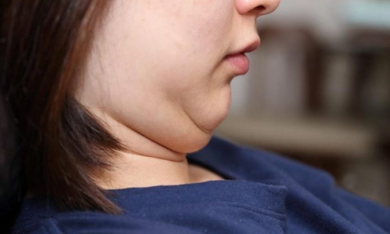 3-Effective-Double-Chin-Removal-Treatments-that-Do-Not-Involve-Diets-or-Exercise-696x464