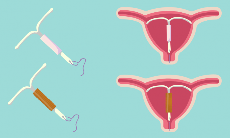 Birth control - IUD