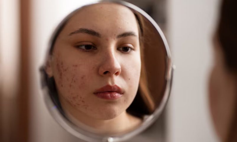 Person dealing with acne