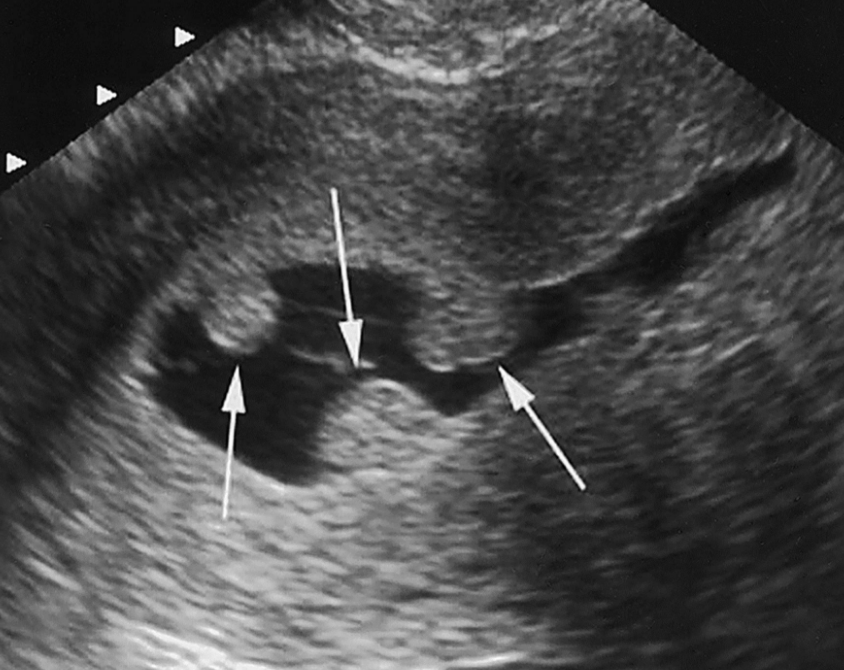 image of saline sonogram showing 2 polyps in the endometrial cavity
