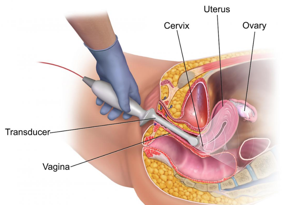 trans-vaginal ultrasound pelvis
